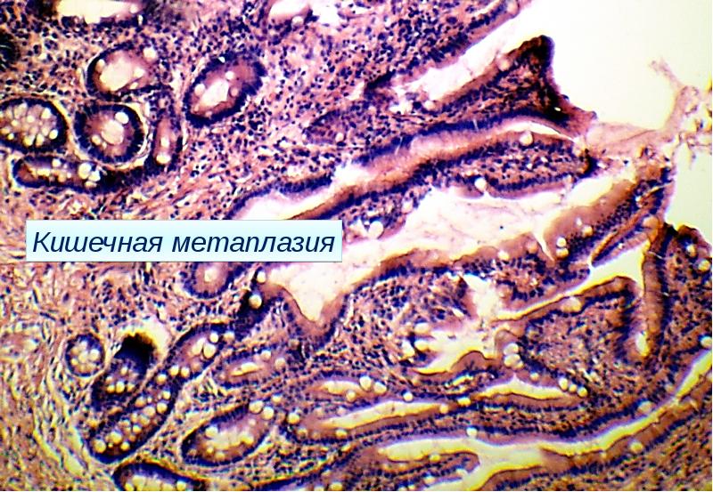 Кишечная метаплазия желудка. Кишечная метаплазия желудка микропрепарат. Кишечная метаплазия желудка гистология. Железистая метаплазия. Кишечная метаплазия гистология.