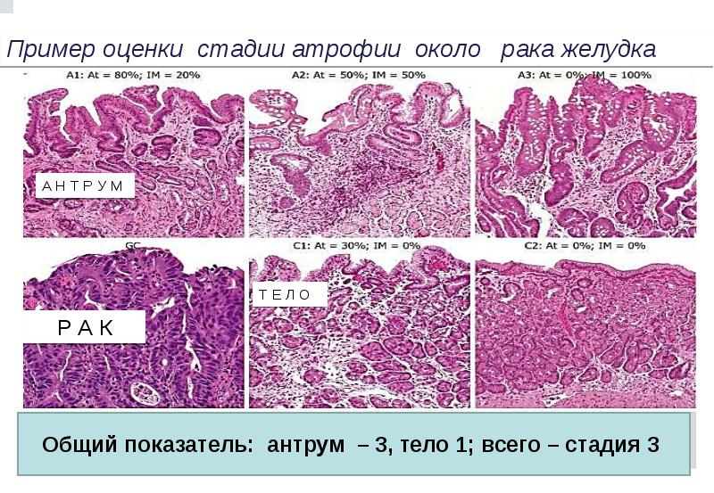 Морфологическая картина полипа