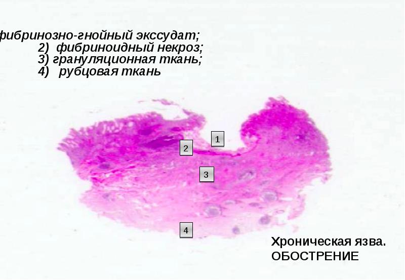 Хроническая язва желудка микропрепарат