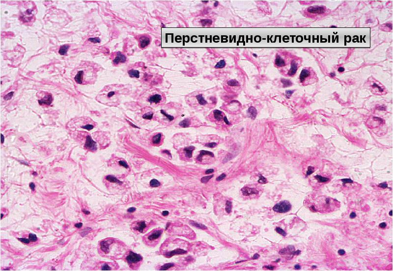 Аденокарцинома морфология