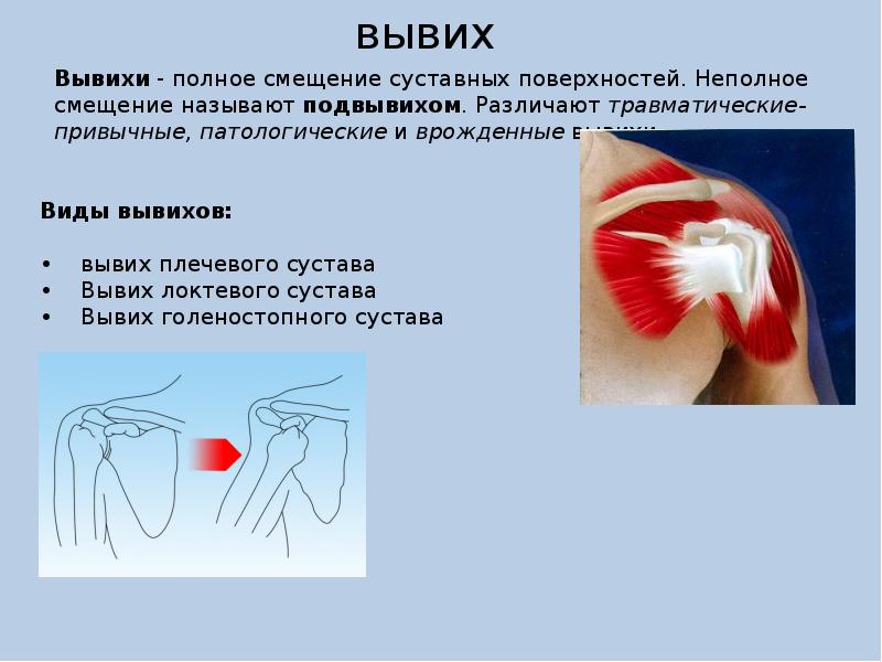 Вывих это. Причины патологических вывихов. Механизм возникновения вывихов. Патологический вывих возникает при.