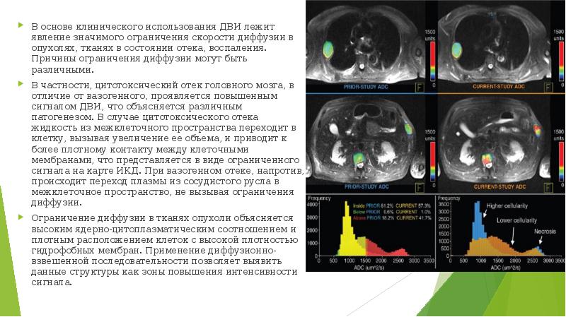 На т2 взвешенных изображениях при нативной магнитно резонансной томографии хорошо визуализируются