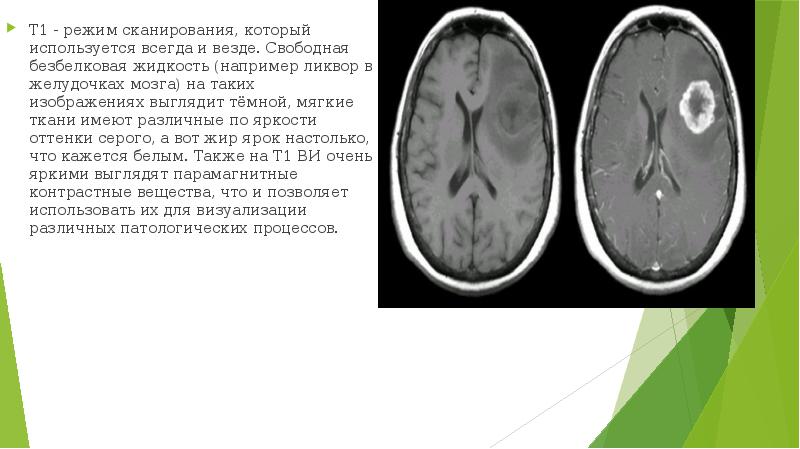 На т2 взвешенных изображениях при нативной магнитно резонансной томографии хорошо визуализируются