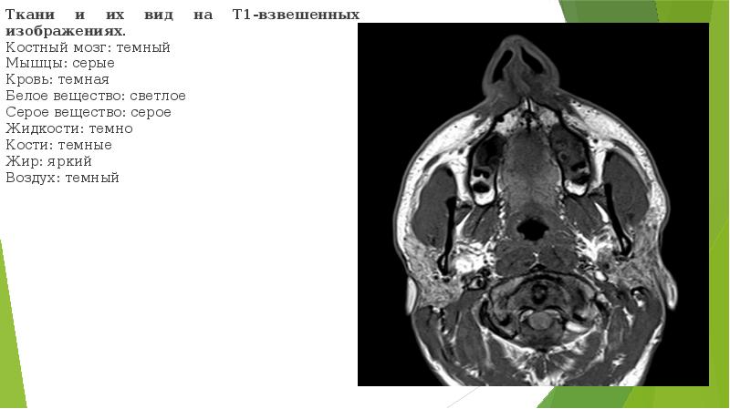 Т1 и т2 взвешенные изображения в мрт отличия