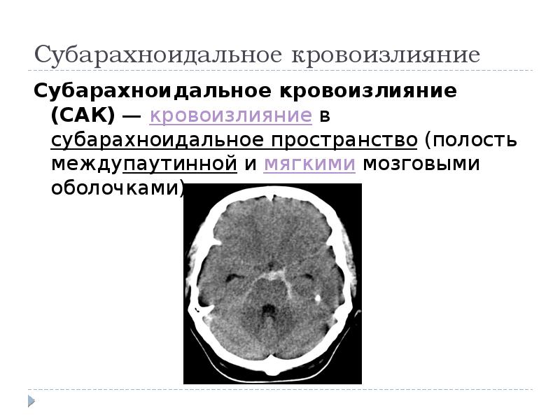 Сосудистые заболевания головного мозга презентация