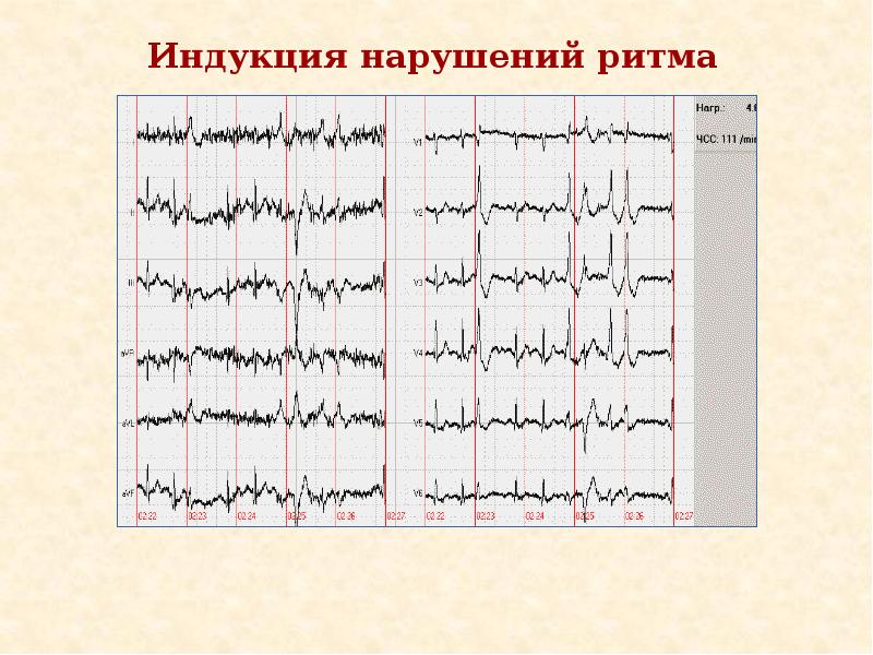 Верхняя запись. Нагрузочные тесты ЭКГ. Тредмил тест ЭКГ. Нагрузочное ЭКГ тестирование рекомендации. Кардиограмма под нагрузкой.