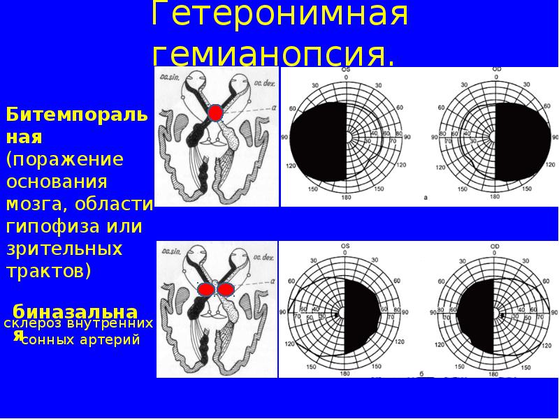 Моторные зрительные функции. Гетеронимная гемианопсия. Квадрантная гемианопсия. Зрительные функции. Биназальная гемианопсия.