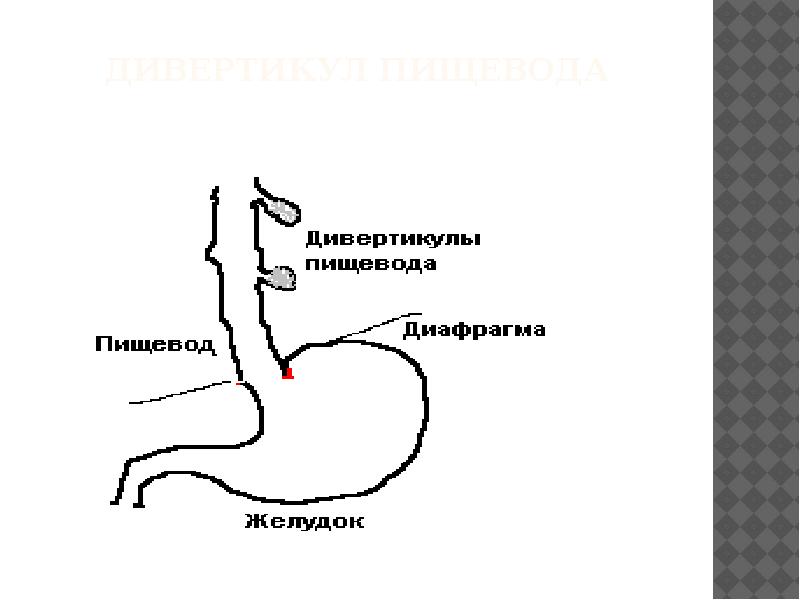 Пищевод обозначен на рисунке. Пищевод-желудок КРС. Дивертикул пищевода методы исследования. Дисфагия при дивертикуле пищевода. Дивертикулы пищевода патогенез.