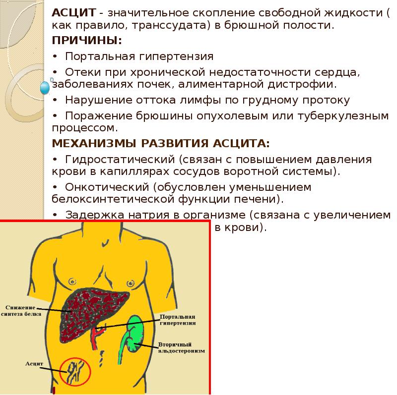 Асцит лечение у мужчин. Жидкость в брюшной полости (асцит). Асцит (скопление жидкости в области живота),. Жидкость в брюшной полости симптомы. Асцит клинические проявления.
