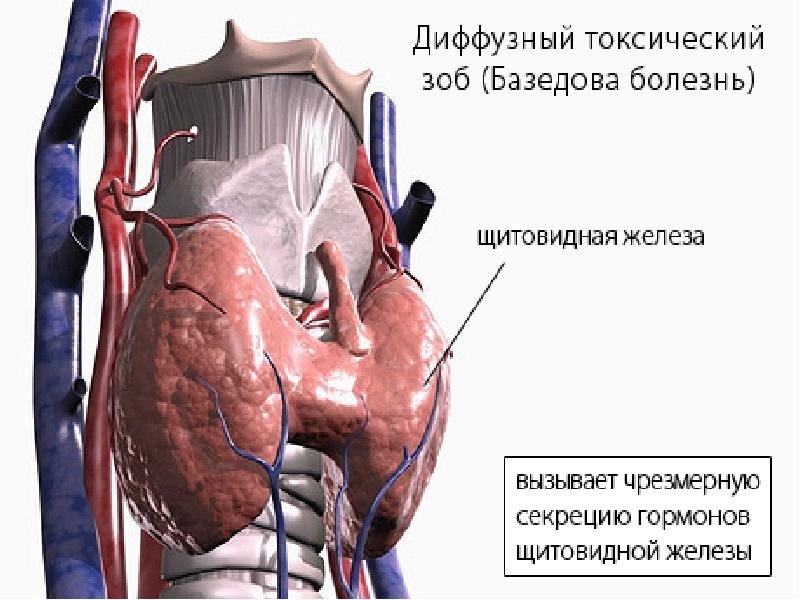 Зоб пищевода. Диффузный коллоидный зоб макропрепарат. Диффузный зоб щитовидной железы.