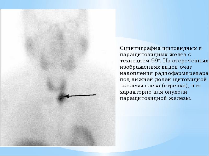 Сцинтиграфия желез. Сцинтиграфии паращитовидной железы. Гиперпаратиреоз сцинтиграфия. Сцинтиграфия при диффузном токсическом зобе. Сцинтиграфия щитовидной железы норма.
