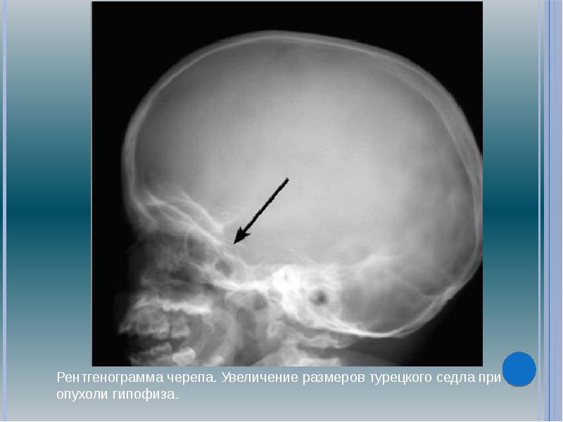 Турецкое седло. Аденома гипофиза рентген черепа. Рентген турецкого седла опухоль гипофиза. Аденома гипофиза рентген турецкого седла. Турецкое седло ТРГ.