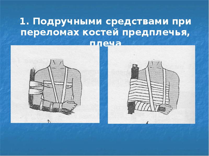 Иммобилизация при переломах костей. Импровизированная шина при переломе. Иммобилизация при переломе костей предплечья. Шины из подручных материалов для иммобилизации. Наложить шину при переломе предплечья.