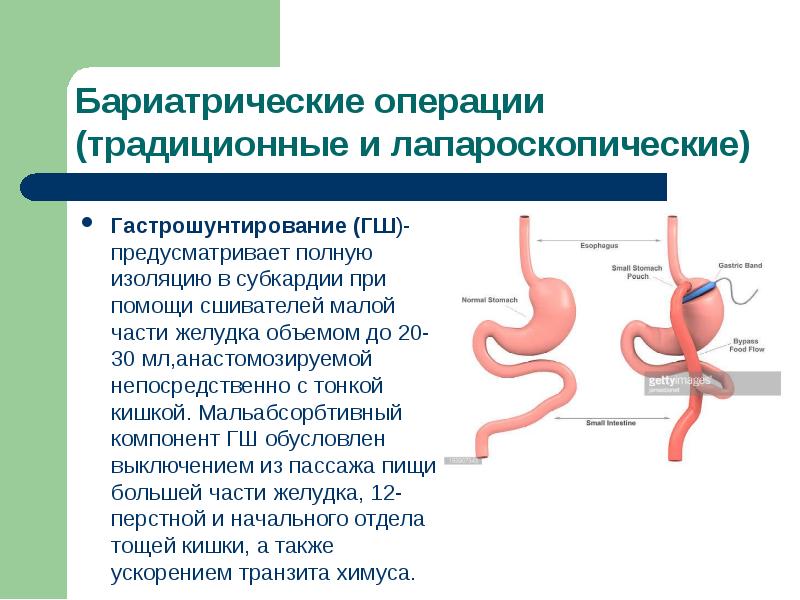 Гастрошунтирование желудка фото