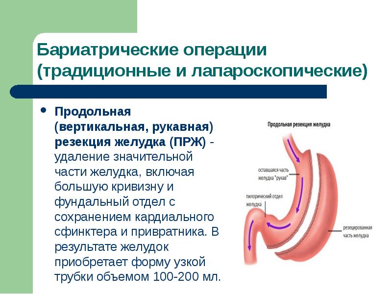 Резекция желудка для похудения отзывы. Бариатрия резекция желудка. Бариатрическая операция на желудке. Продольная резекция желудка бариатрической операции. Бариатрическая операция продольная резекция желудка.