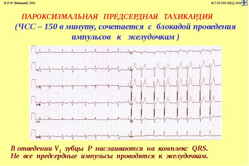 Аритмии патофизиология презентация