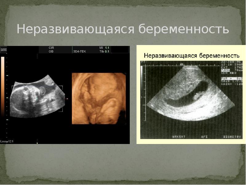 Морфологическая картина неразвивающейся беременности