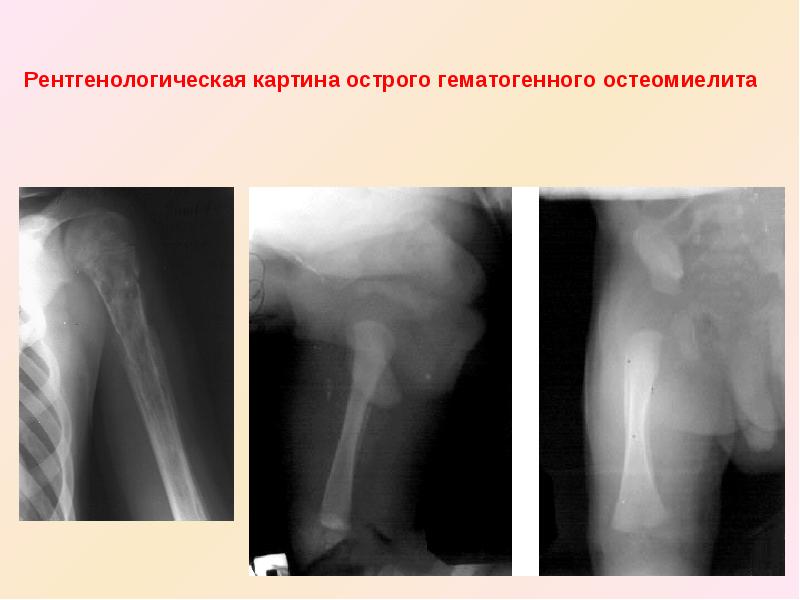 Эпифизарный остеомиелит у детей презентация