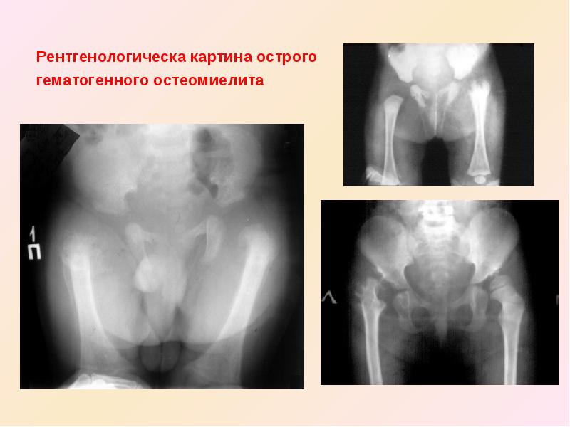 Эпифизарный остеомиелит у детей презентация