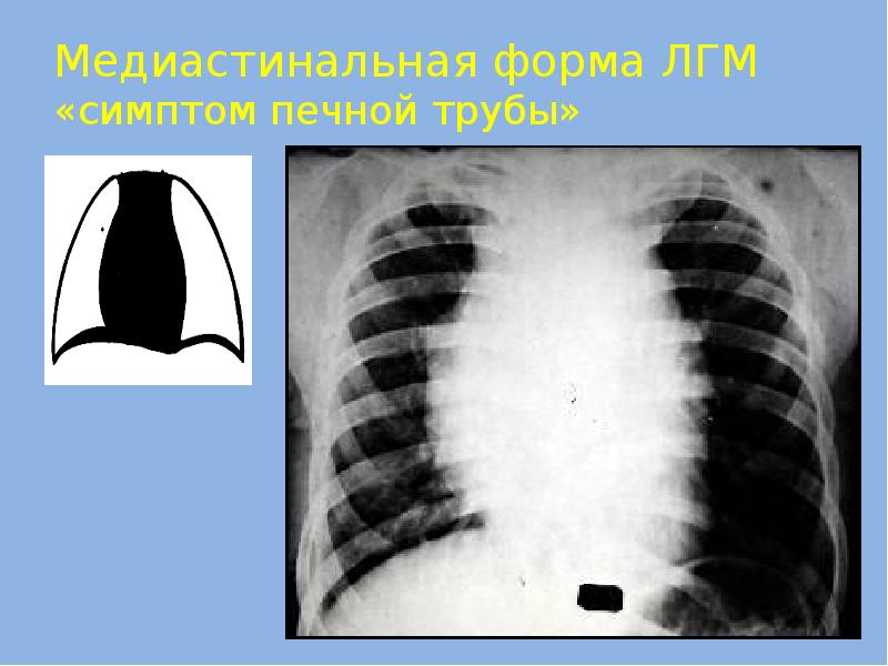 Туберкулез внутригрудных лимфатических узлов презентация