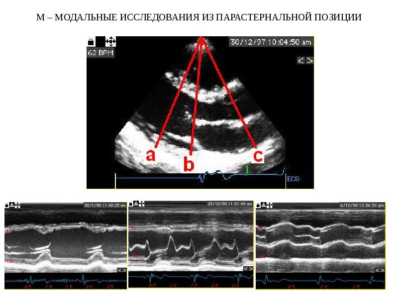 М режим. М-модальное исследование. Допплерография одномерная и двухмерная. Допплерография мочеточниковых выбросов. М модальное исследование митрального клапана.