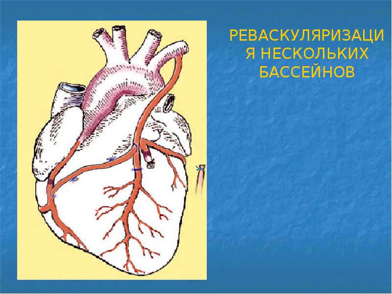 Хирургическое лечение ишемической болезни сердца презентация