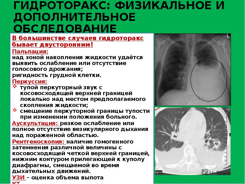 Гидроторакс карта вызова