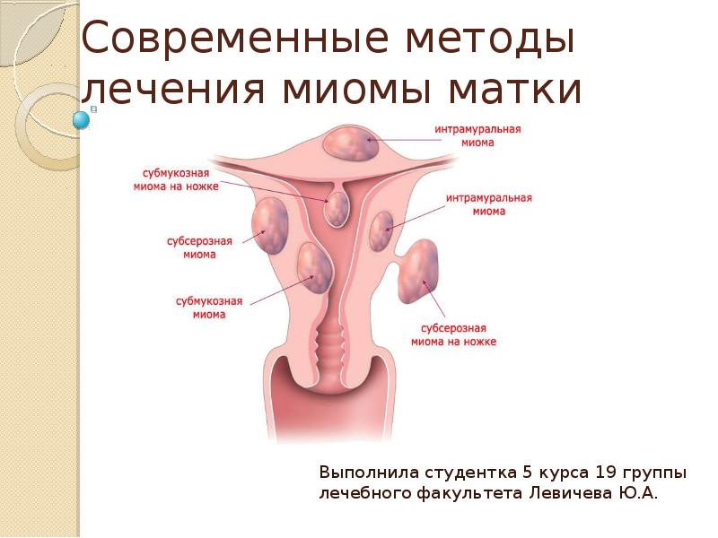 Миома матки субмукозная - причины, симптомы, диагностика, лечение и профилактика