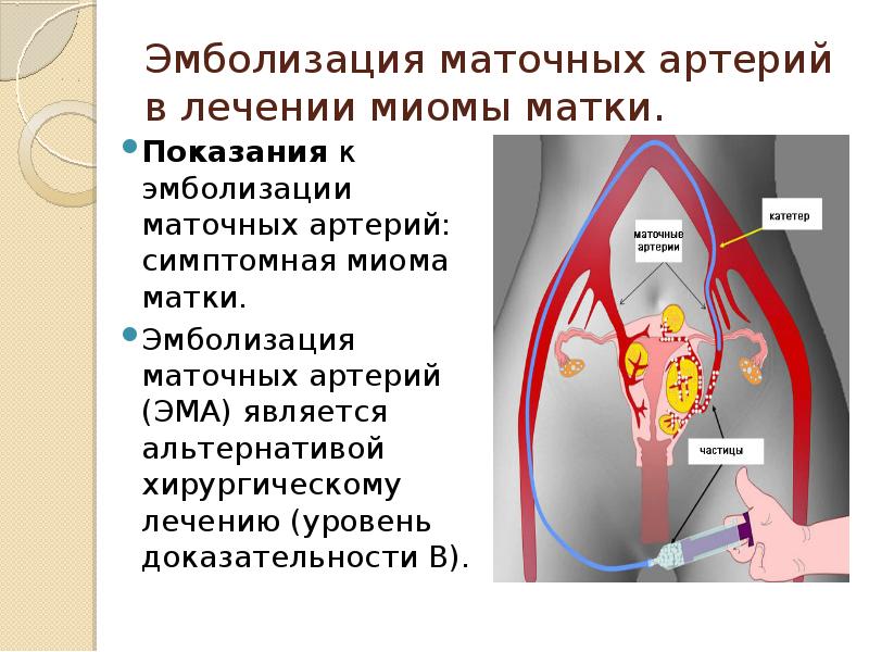 Эмболизация миомы. Эмболизация маточных артерий. Эмболизации маточных артерий. Эмболизация маточных артерий Эма. Эмболизация миомы матки.