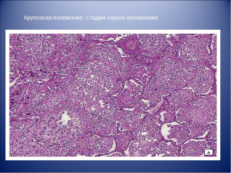Крупозная пневмония. Крупозная пневмония стадия серого опеченения микропрепарат. Пневмококковая пневмония макропрепарат. Крупозная (лобарная) пневмония гистология. Микропрепарат 2 крупозная пневмония красное опеченение.