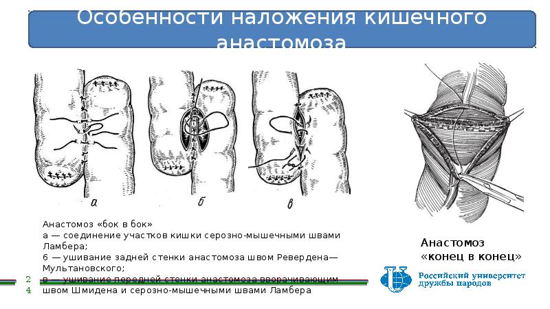 Кишечные анастомозы. Наложение кишечного шва. Наложение анастомоза бок в бок. Кишечный анастомоз бок в бок.