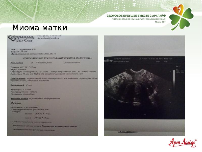 Матка 40. Миома матки при беременности на ранних сроках. Эхопризнаки миомы матки. Миома при беременности на ранних сроках. Миома матки и плодное яйцо.