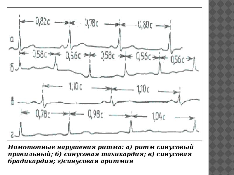 Нарушение синусового. Нарушение функции АВТОМАТИЗМА синусового узла. Время восстановления функции синусового узла. Синусовый узел функции. Функция АВТОМАТИЗМА синусового узла.