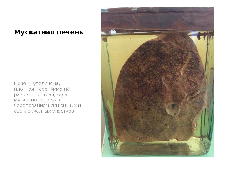 Мускатная печень
Печень увеличена, плотная.Паренхима на разрезе пестрая,вида мускатного ореха,с чередованием Мускатная печень
Печень увеличена, плотная.Паренхима на разрезе пестрая,вида мускатного ореха,с чередованием