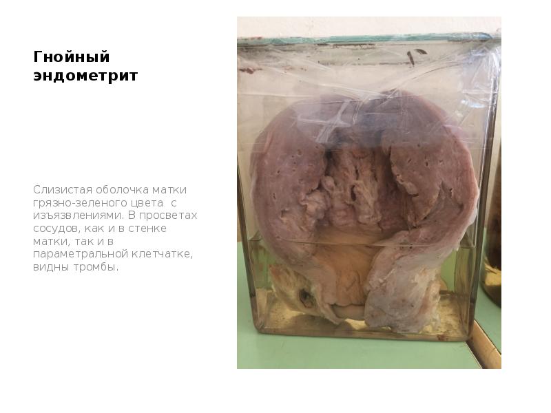 Гнойный эндометрит
Слизистая оболочка матки грязно-зеленого цвета с изъязвлениями. В просветах Гнойный эндометрит
Слизистая оболочка матки грязно-зеленого цвета с изъязвлениями. В просветах