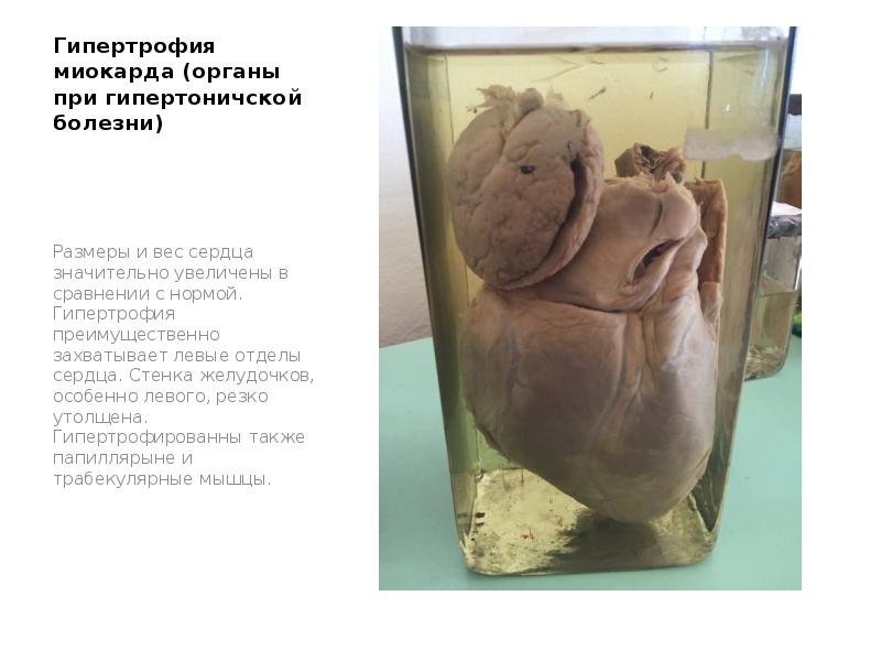 Гипертрофия миокарда (органы при гипертоничской болезни)
Размеры и вес сердца Гипертрофия миокарда (органы при гипертоничской болезни)
Размеры и вес сердца