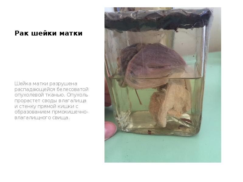 Рак шейки матки
Шейка матки разрушена распадающейся белесоватой опухолевой тканью. Опухоль Рак шейки матки
Шейка матки разрушена распадающейся белесоватой опухолевой тканью. Опухоль