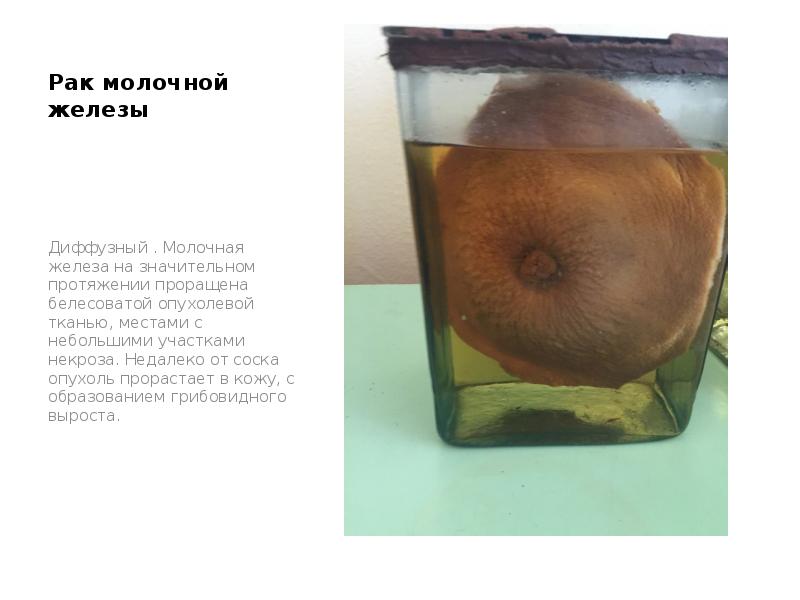 Рак молочной железы
Диффузный . Молочная железа на значительном протяжении проращена Рак молочной железы
Диффузный . Молочная железа на значительном протяжении проращена