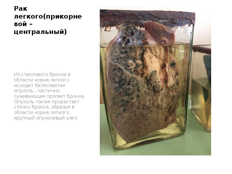 Рак легкого(прикорневой – центральный)
Из стволового бронха в области корня легкого Рак легкого(прикорневой – центральный)
Из стволового бронха в области корня легкого