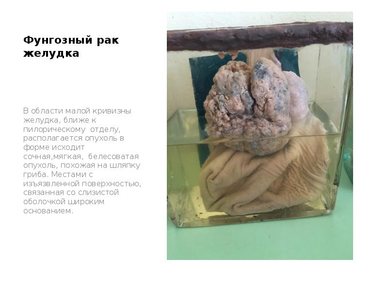 Фунгозный рак желудка
В области малой кривизны желудка, ближе к пилорическому Фунгозный рак желудка
В области малой кривизны желудка, ближе к пилорическому