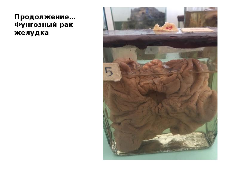 Продолжение… Фунгозный рак желудка Продолжение… Фунгозный рак желудка