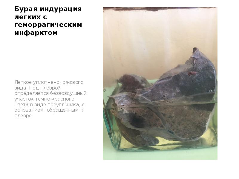 Бурая индурация легких с геморрагическим инфарктом
Легкое уплотнено, ржавого вида. Под Бурая индурация легких с геморрагическим инфарктом
Легкое уплотнено, ржавого вида. Под