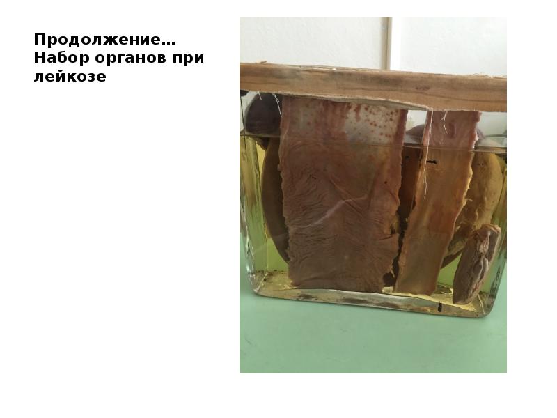 Продолжение… Набор органов при лейкозе Продолжение… Набор органов при лейкозе