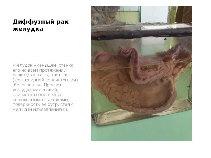 Диффузный рак желудка
Желудок уменьшен, стенка его на всем протяжении резко Диффузный рак желудка
Желудок уменьшен, стенка его на всем протяжении резко