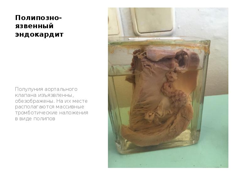 Полипозно-язвенный эндокардит
Полулуния аортального клапана изъязвленны, обезображены. На их месте располагаются Полипозно-язвенный эндокардит
Полулуния аортального клапана изъязвленны, обезображены. На их месте располагаются