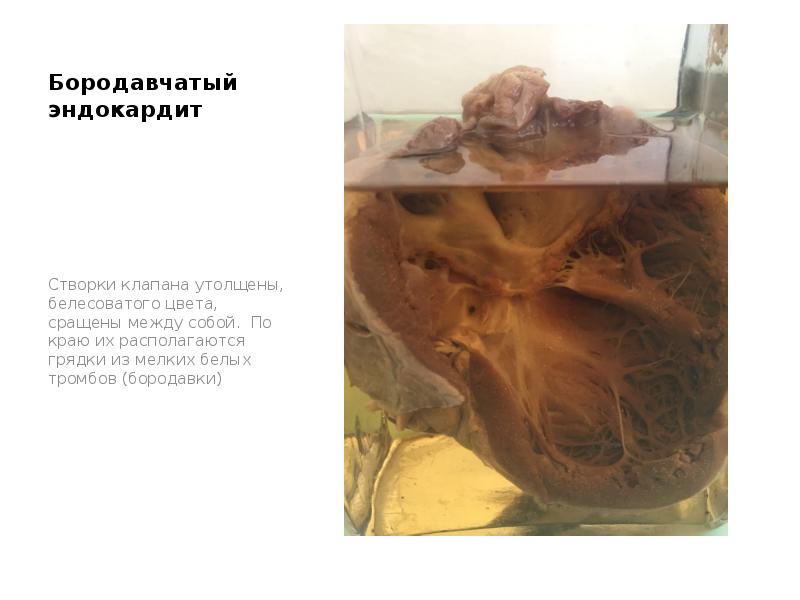 Бородавчатый эндокардит
Створки клапана утолщены, белесоватого цвета, сращены между собой. По Бородавчатый эндокардит
Створки клапана утолщены, белесоватого цвета, сращены между собой. По