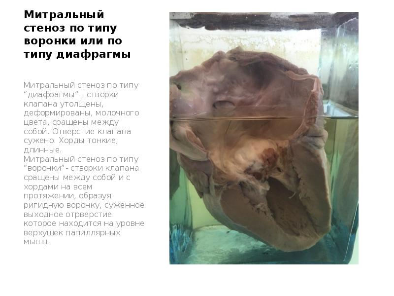 Митральный стеноз по типу воронки или по типу диафрагмы
Митральный стеноз Митральный стеноз по типу воронки или по типу диафрагмы
Митральный стеноз