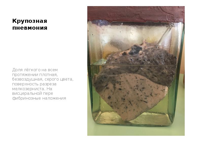 Крупозная пневмония
Доля лёгкого на всем протяжении плотная, безвоздушная, серого цвета, Крупозная пневмония
Доля лёгкого на всем протяжении плотная, безвоздушная, серого цвета,