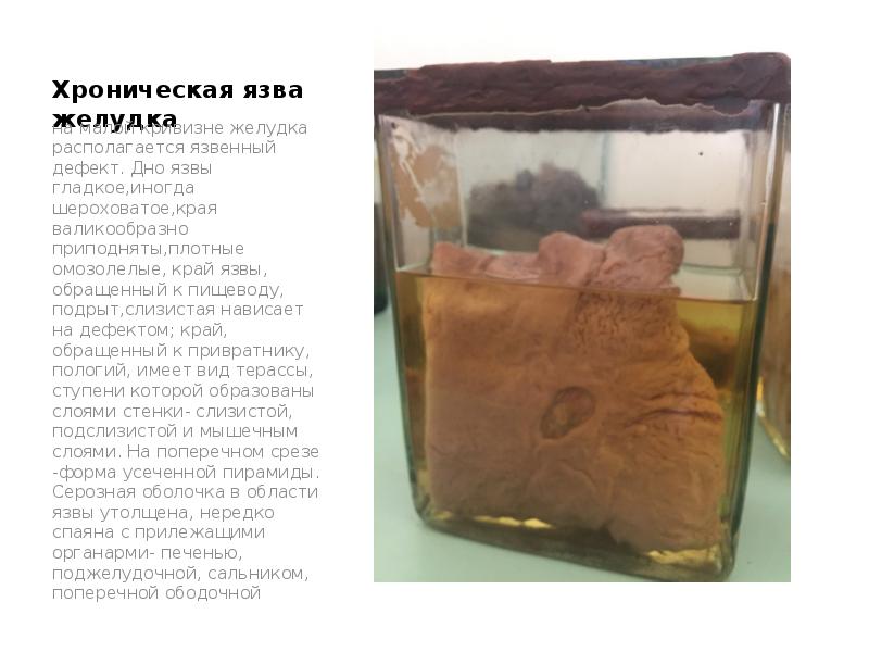 Хроническая язва желудка
на малой кривизне желудка располагается язвенный дефект. Дно Хроническая язва желудка
на малой кривизне желудка располагается язвенный дефект. Дно