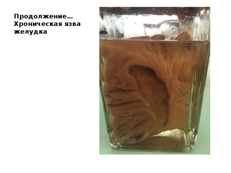Продолжение… Хроническая язва желудка Продолжение… Хроническая язва желудка